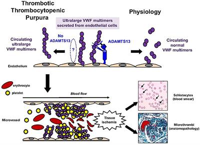 Molecular Diagnosis Is Vital to the Accurate Classification and Management of Thrombotic Thrombocytopenic Purpura in Children